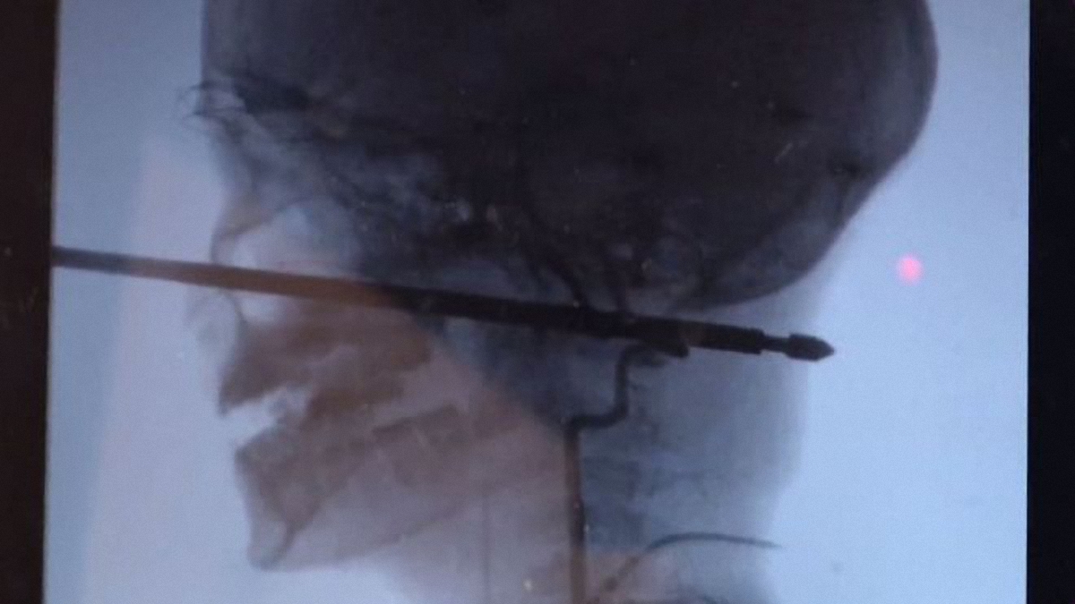На рентгеновском снимке видно, как шампур пробил голову мальчика  - фото 1