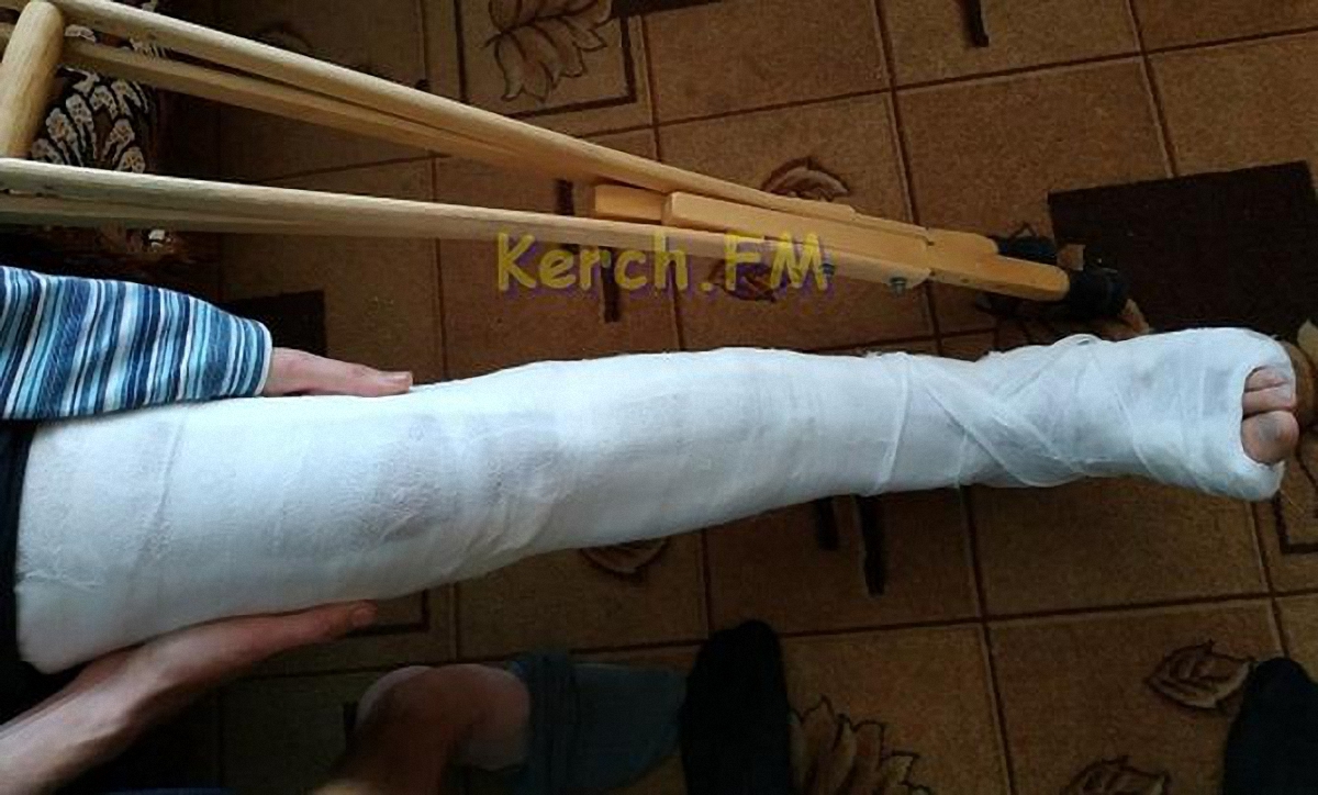 В Крыму террористы сломали больному шизофренией парню ногу - фото 1