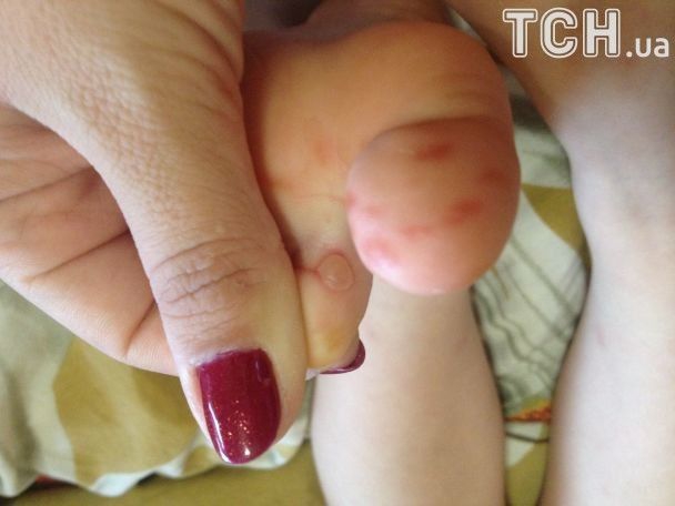 В киевском детсаду дети массово подхватили вирус Коксаки - 75624 В киевском детсаду дети массово подхватили вирус Коксаки - фото 75624