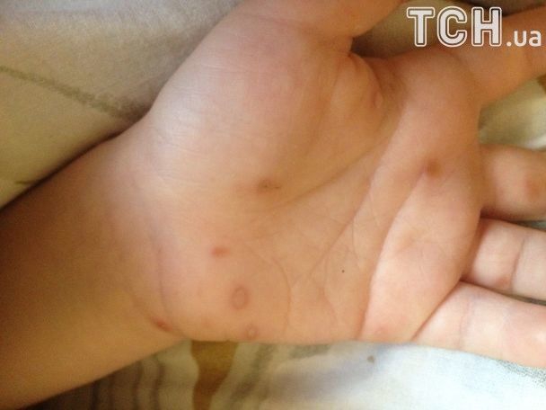 В киевском детсаду дети массово подхватили вирус Коксаки - 75622 В киевском детсаду дети массово подхватили вирус Коксаки - фото 75622